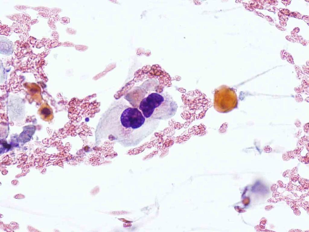 Lung, left, CT-guided FNA: Papanicolaou stain, 40x Presentation material is for