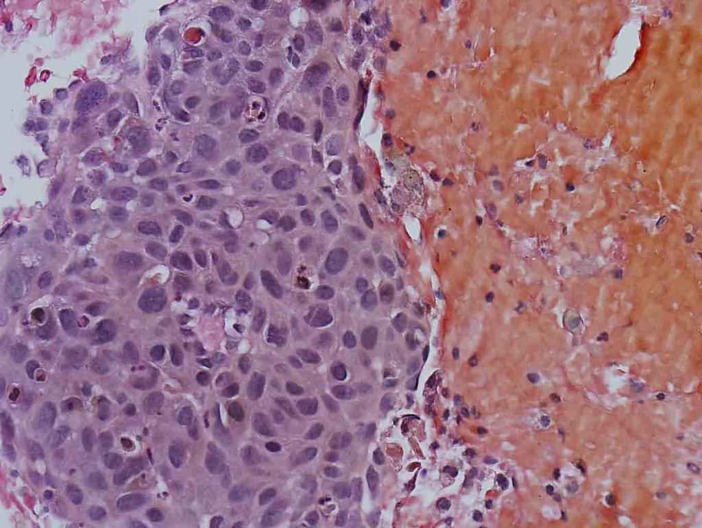 Lung, left, Cell Block: Mucin stain, 40x Presentation material is for