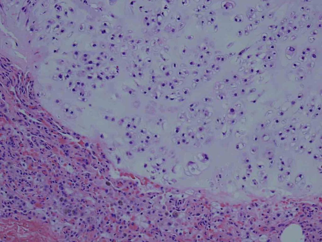 Lung, right lower lobe, wedge resection: H & E stain, 10x Presentation material is