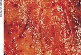 Causes of Upper GI Bleed 5) Stress ulcers 6) Arteriovenous