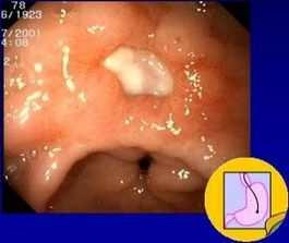 Duodenal Bleeds Ulcer: history, usually melena present, risk factors, coffee