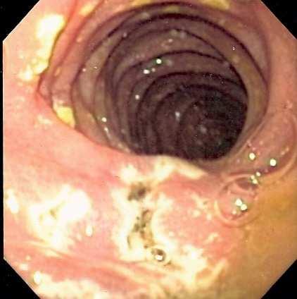 Zollinger Ellison syndrome Is a triad of gastric acid hypersecretion + severe peptic ulceration + non-beta cell islet tumor of pancreas (gastrinoma).