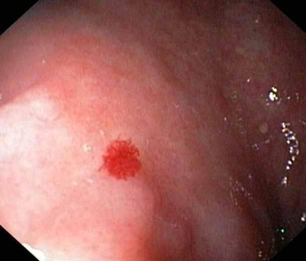 Causes of bleeding Less common Dieulafoy s lesion Gastric antral vascular