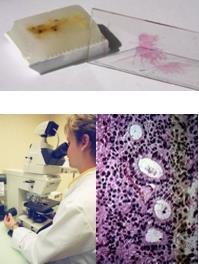 Tissue biopsy vs.