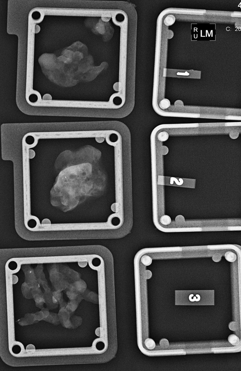 Fig.: Specimen radiographs demonstrating microcalcification within VAB samples following On this occassion, 3 sets of 6 cores samples have been obtained without withdrawing the probe.
