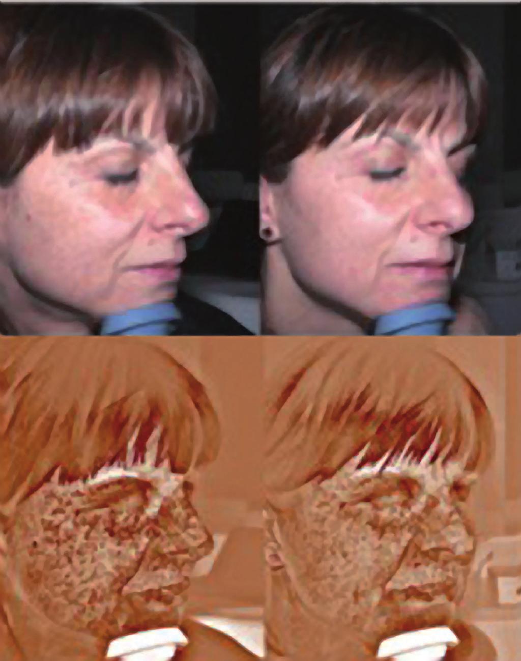 Patient 2 Clinical trials 1- Patients with melasma Bellow, photos of patient with skin type III treated with MELINE 01 CAUCASIAN SKIN following a protocol of 2 professional treatment sessions at the