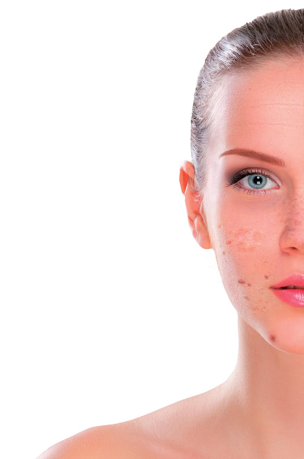2- Specific depigmentation treatments for different types of hyperpigmentation The dark spots caused by chronic sun exposure can be of two types: lentigo or melasma.