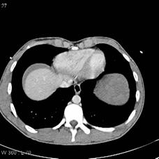 abdominal organs after blunt or penetrating trauma To discuss the MDCT imaging features of acute