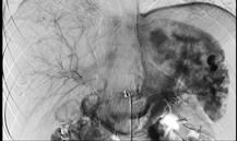 Trauma: Spleen Evidence of CM pooling caused by vascular or visceral organ pathology Attenuation