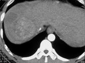 left-sided kidney