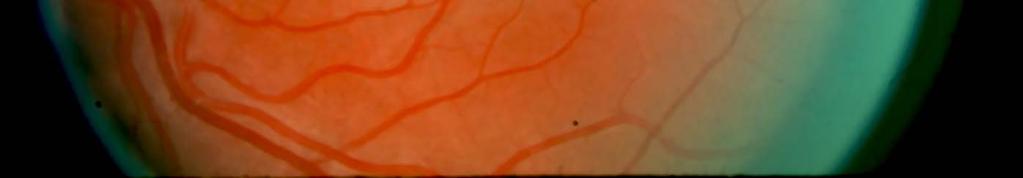 The point where the central retinal artery enters and the central retinal vein leaves. 4.