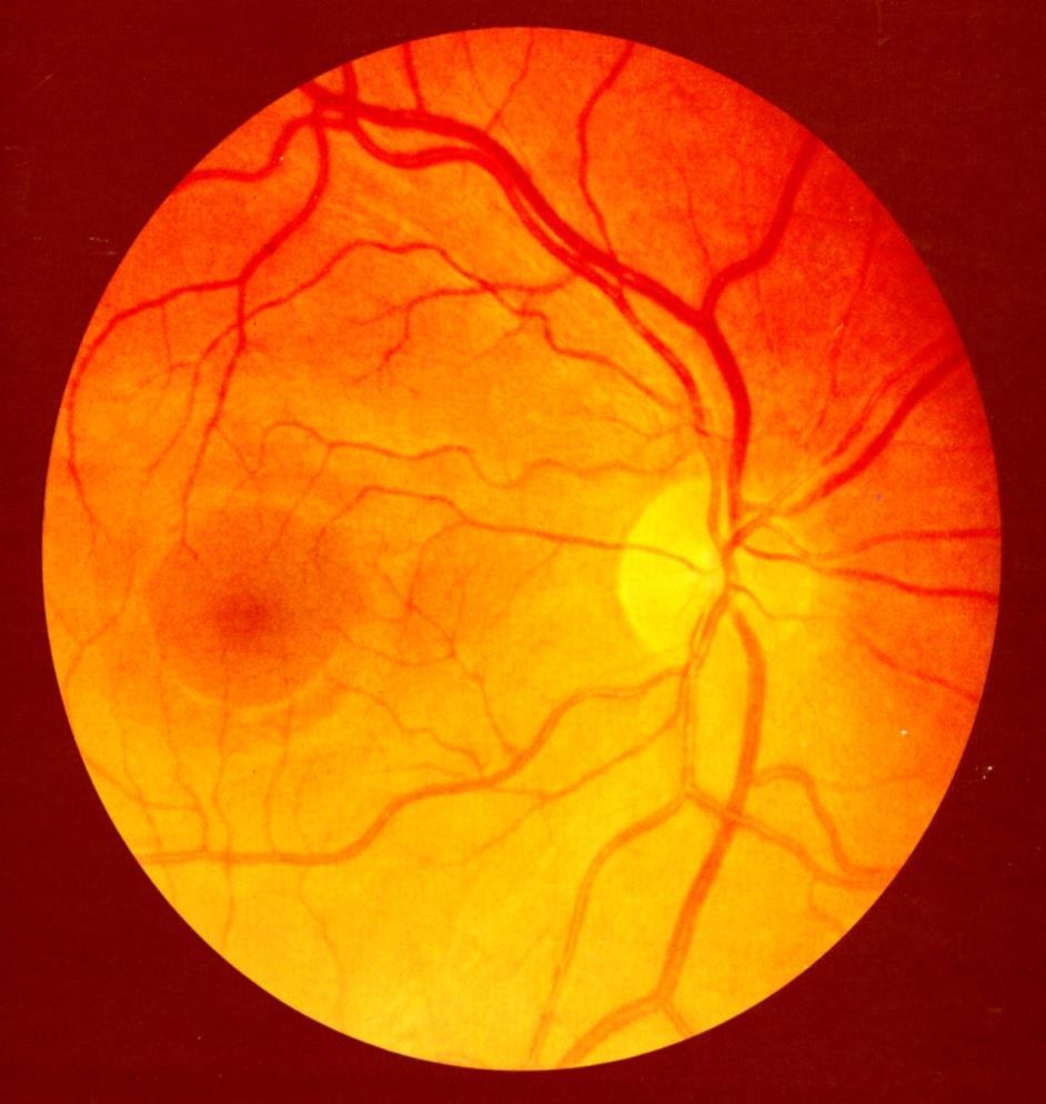 Optic Nerve (CN II) The axons from retinal ganglion cells across the retina run to the optic nerve head.
