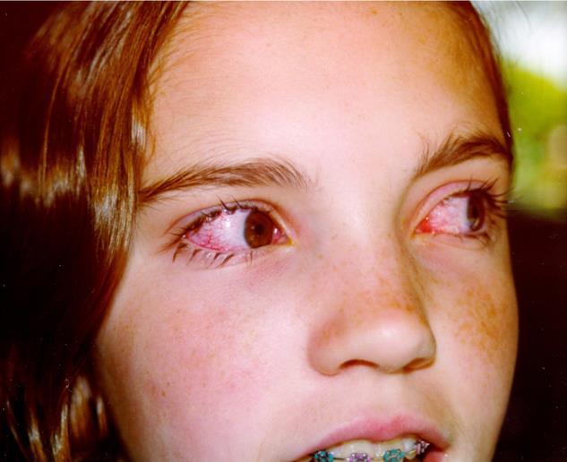 Eye Conjunctivitis (pink eye) is inflammation of the