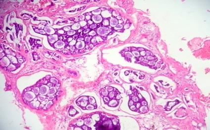 pleomorphic adenoma 40X view Figure 4: H&E showing oncocytic cells