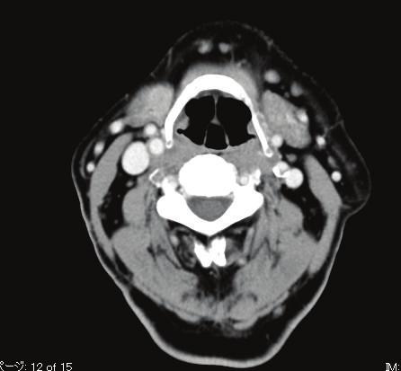 2 Case Reports in Otolaryngology Figure 1: Neck CT showing a 20 mm 10 mm nodular shadow with slight enhancement in the right submandibular area.