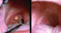 The yellowish plug of bacteria has been removed easily and shows the open crypt, right. Figure 2.31. Pseudocyst/oral lymphoepithelial cyst of the palatine tonsil, left.