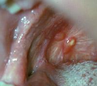 One is a band of white that represents scar tissue. The other is a mass of tonsillar tissue called residual tonsil (Figure 2.33). These fleshy masses may become reactive remain enlarged.