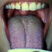The tongue can be viewed next, by holding it with a gauze and gently moving it, or by having the patient move it from side to side, while holding the buccal mucosa to the side, and forward while