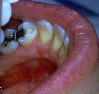 Hyperplastic, reactive oral tonsil in the floor of the mouth. In the normal state, it would not be apparent.