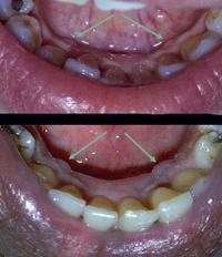 With a dental mirror and by direct viewing, the unattached and attached gingivae should be noted (Figure 2.52). The mucogingival line should be seen and the amount of attached tissue noted.