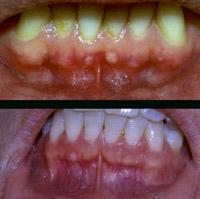 Figure 2.55. Gingival fibrous nodules at the mucogingival junction on the attached gingiva in two separate patients.