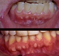 Figure 2.56. Gingival fibrous nodules at the mucogingival junction on the attached gingiva in two separate patients.