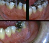 Found on the molar attached gingivae, they appear as small, white to pink, linear slightly raised lesions (Figure 2.57).