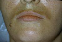 Figure 2.4. Facial view of patient with a large, pigmented mole on the right side of her face. The mole has melanin pigment.