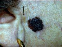There are two pigmented lesions. The darkbrown, larger one with irregular borders is a melanoma, a malignant skin tumor of nevus cells.