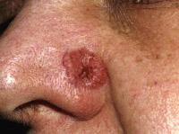 It is a non-healing, crater-like ulcer with rolled margins. Lymph nodes are concentrations of lymphatic tissue with T cells, B cells and macrophages which recognize antigens and mount a response.