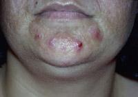 The lower lip, lower anterior gingivae, corners of the mouth, and skin and tissue of the chin drain to the submental node.