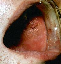 Figure 2.22. Buccal mucosa with a prominent papilla of Stensen duct with an expression of clear, watery saliva from the parotid gland.