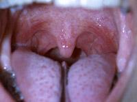 Moving posteriorly with the examination, one envisions the soft palate which ends at a pendulous structure, the uvula (Figure 2.26).