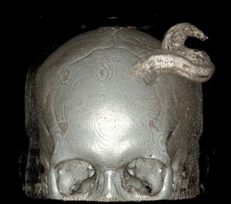 history of a growth on her frontal scalp. She reported the mass grown over a two-year period, became painful, and occasionally bled from the base. She denied any other associated symptoms.
