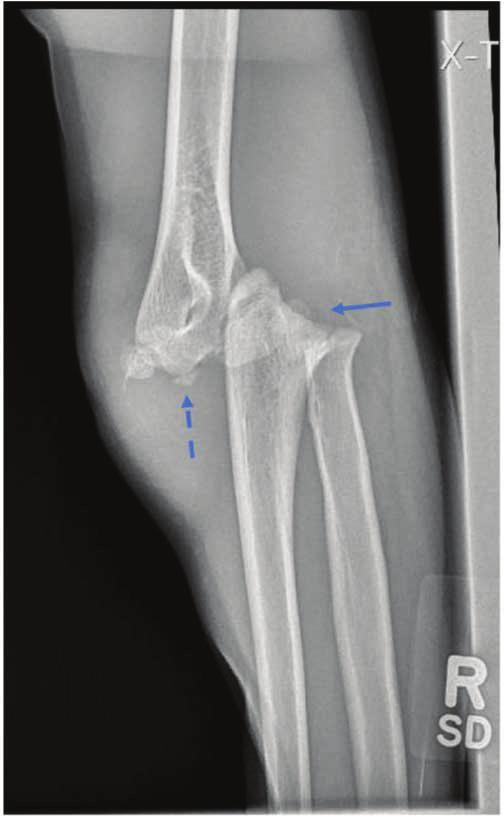 The dashed arrow points to an ossific fragment near the distal humerus which likely represents the olecranon avulsion.