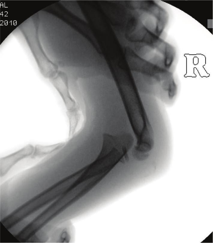 The Salter-Harris II fracture of the radial head can again be noted. freed from the anterior capsule, it was easily reduced into its anatomic position (Figure 3).