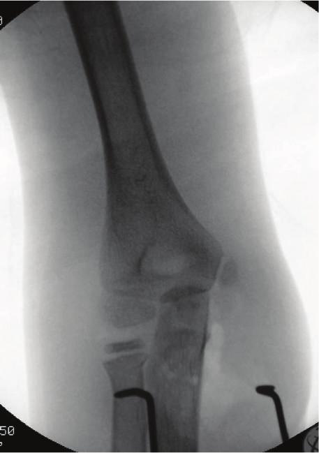 Case Reports in Orthopedics 3 Figure 3: AP and lateral radiographs of the right elbow demonstrating anatomic reduction of both the ulnohumeral and radiocapitellar joints.