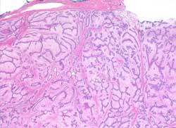 Fibroadenoma Fibroadenomas are derived from the breast lobule, pathogenesis is unclear They have both epithelial and connective tissue elements, therefore can undergo hormonaly induced changes as in