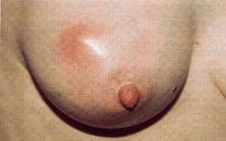 Pain Infection Lactational infections Due to cracks in nipple Usually peripheral Usually Staph.