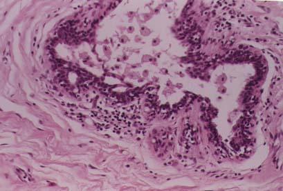 Mammary Duct Ectasia Duct contains foamy histiocytes