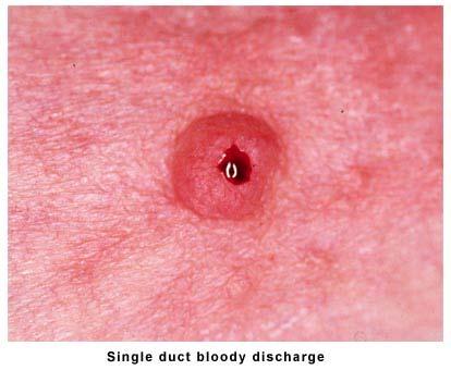 Nipple Discharge Description of nipple discharge Unilateral or