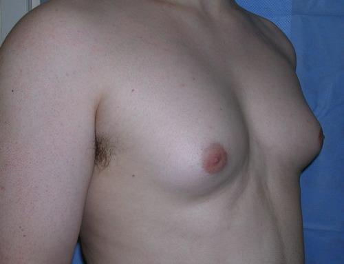 Gynaecomastia Aetiology Most cases are idiopathic Physiological causes are due to relative oestrogen excess Physiological causes Neonatal Puberty Senile Pathological causes Primary