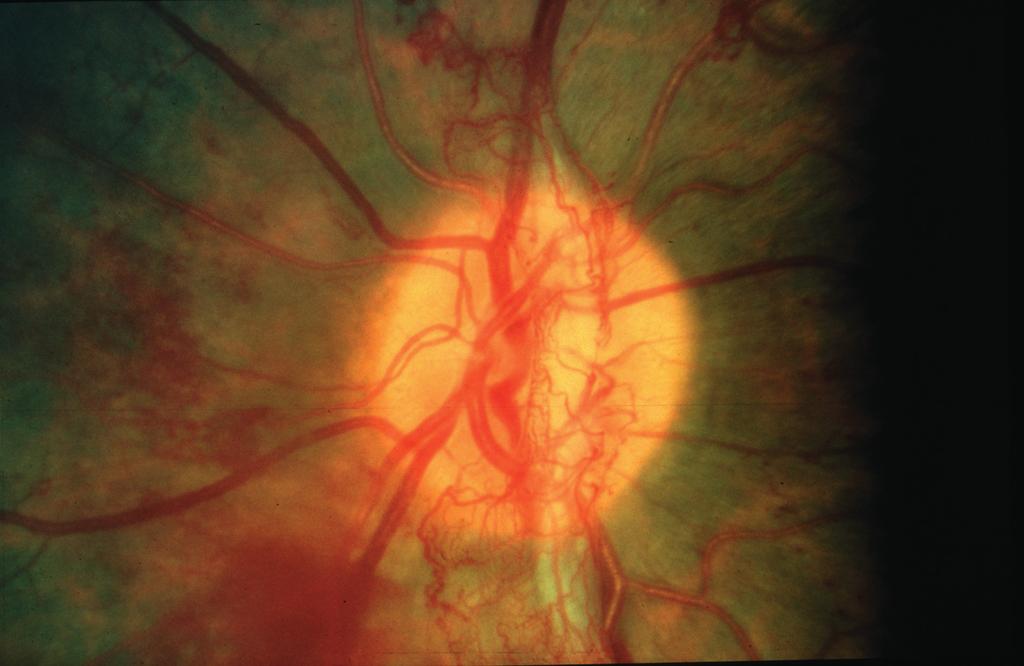 Laser treatment should use small spots and just enough power to produce a visible reaction. Proliferative retinopathy is best treated with pan-retinal laser.