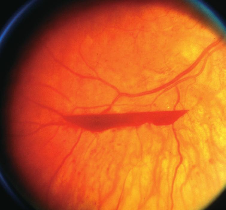 Vitrectomy is useful for vitreous haemorrhage and late complications of proliferative retinopathy. Pre-treatment with bevacizumab reduces the risk of surgical complications.