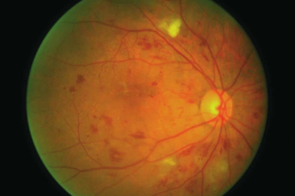 Haemorrhages (larger, uneven red blots ) and microaneurysms (small, round dots ) Figure 3. Intraretinal microvascular abnormalities (IRMA).