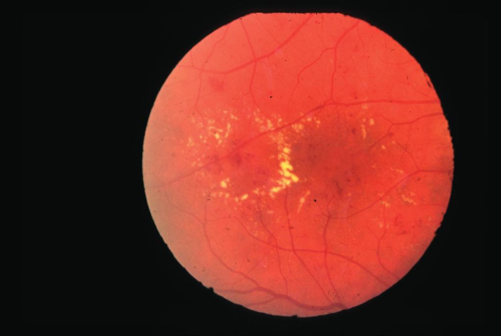 DIAGnOSIS AnD MAnAGEMEnT Continued 3 Diabetic maculopathy Diabetic maculopathy occurs when DR affects the central part of the retina.