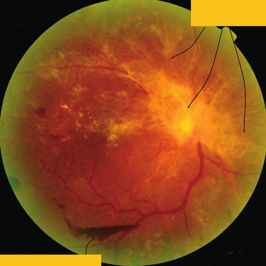 DIAGnOSIS AnD MAnAGEMEnT Continued treatment of diabetic maculopathy are ranibizumab2 (Lucentis) and bevacizumab5 (Avastin).