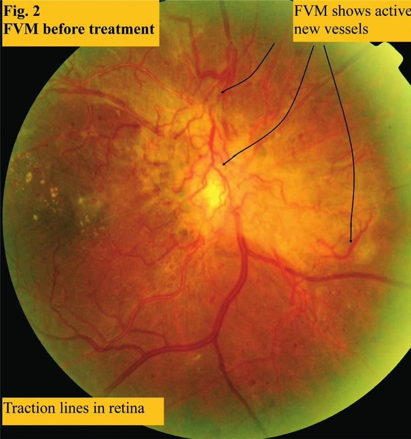 The treatment plan followed the textbook recommendation of doing focal laser for the maculopathy first.