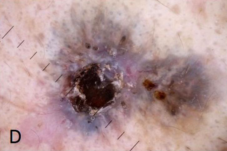 Clinical Diagnosis of BCCs and SCCs In dermoscopic findings, blue-gray nests and globules, arborizing vessels, and ulceration were dominant features for BCC, whereas keratin formation, white