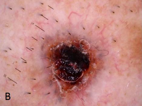Basosquamous cell carcinoma appeared as basal cell carcinoma or squamous cell